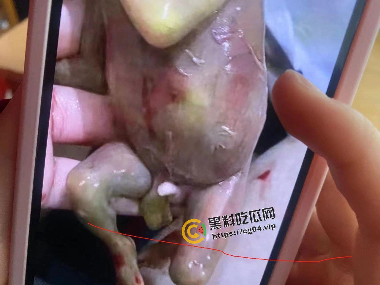 广西商业技师学幼教专业女生厕所早产 四度撕裂 母子双双进ICU-7