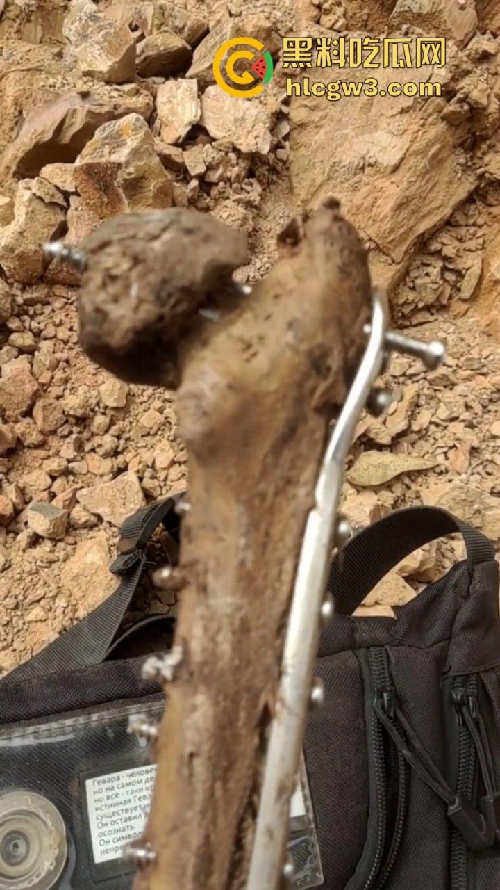 大妈去世后尸骨爆出惊人秘密 广西玉林大化骨科医院恐怖接骨手术让人震惊-3