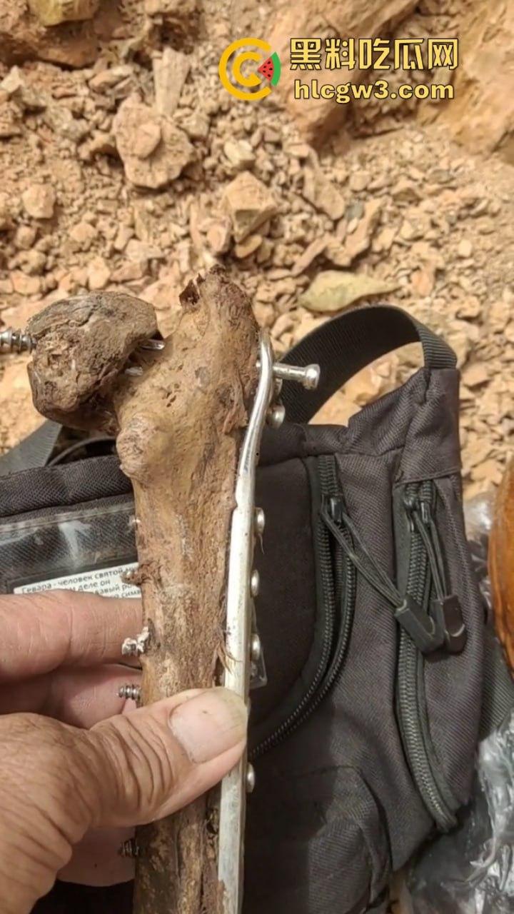 大妈去世后尸骨爆出惊人秘密 广西玉林大化骨科医院恐怖接骨手术让人震惊-5